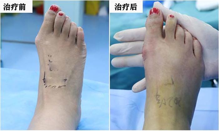 超微创专业技术，济南关节外科医院让拇外翻患者实现夏季穿鞋自由