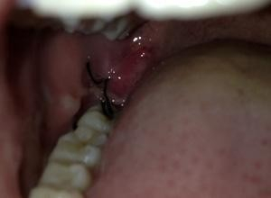 磨牙后垫红肿 - 搜狗百科