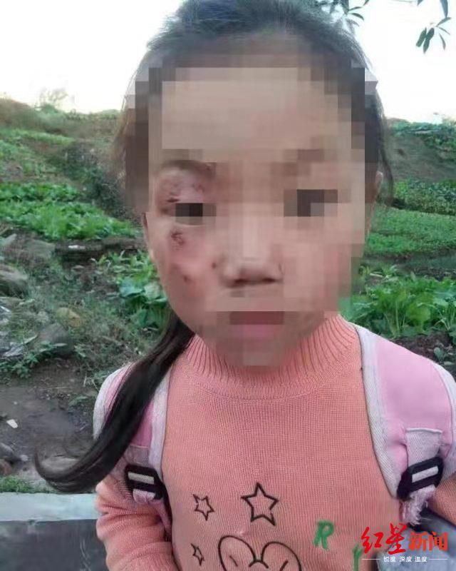 网传江安女童遭“后奶奶”虐待，当地回应确有此事：监护权已临时变更