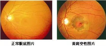 新研究有望帮助黄斑变性致盲患者恢复视力
