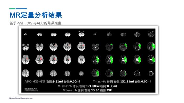 点CT定量分析结果示意图