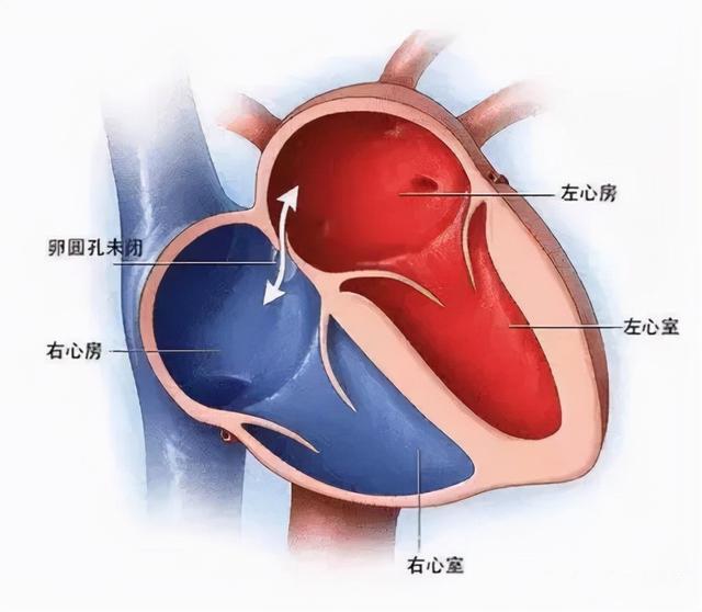 「突破」填补心房“小洞”，大足区人民医院首例“经食管超声引导下卵圆孔未闭封堵术”