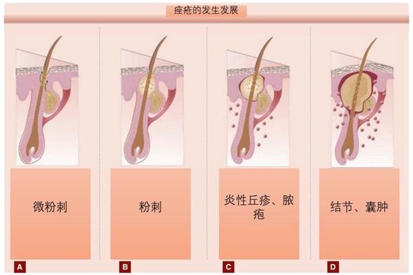 春夏祛痘它才是绝绝子！是谁还没拥有欧利芙洋Oliveyoung这款王炸级痘贴？