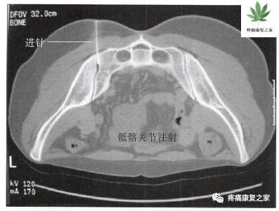 骶髂关节穿刺技巧