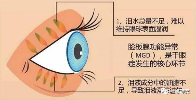 眼睛痒痛、有异物感，别大意，可能是患了干眼症→