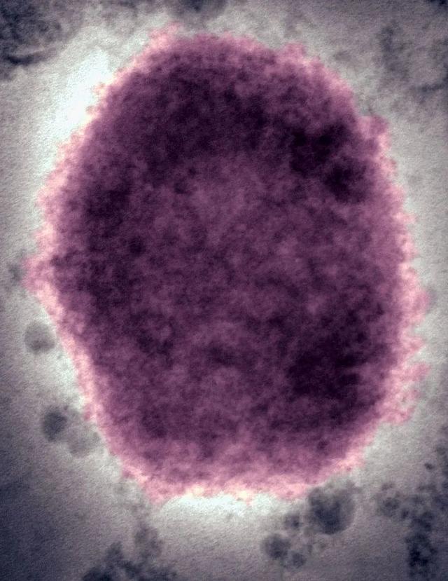 国际观察丨猴痘病毒已发生人际传播，会成为下一场全球大流行病吗？