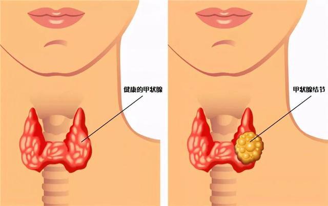 国际甲状腺知识宣传周｜发现甲状腺结节后该怎么办？