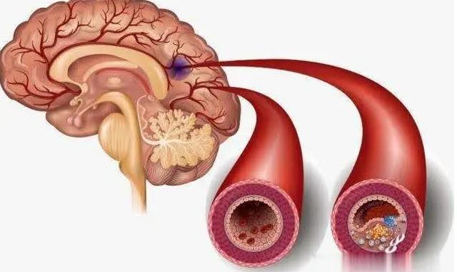 北京正中堂中医医院专家雷秀珍：远离脑梗塞 治疗血管斑块是关键