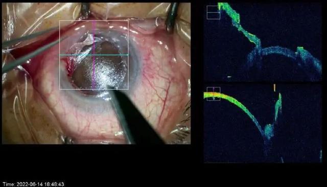 上海市同济医院眼科完成首例术中OCT联合微型角膜刀辅助低温保存角膜移植术
