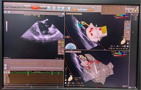 告别全麻和“食管异物”，十院成功开展3D心腔内超声下的房颤消融术