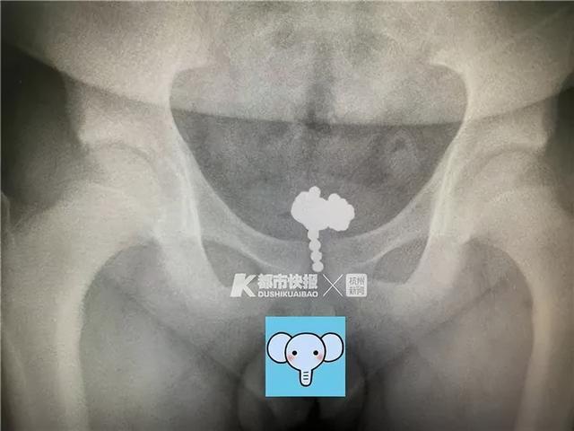 10岁男童将74颗珠子塞进尿道，医生：每年都有这样的孩子，甚至还有掏耳勺