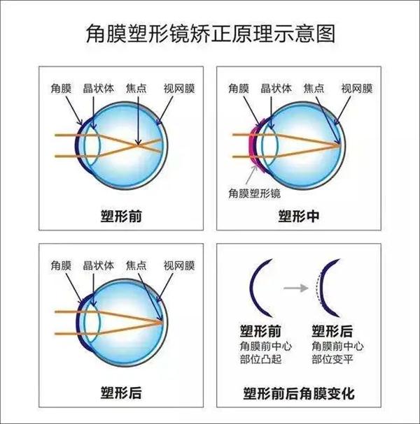 暑假摘镜总动员|暑期近视防控注意事项？合肥普瑞视光专家问答详解来啦