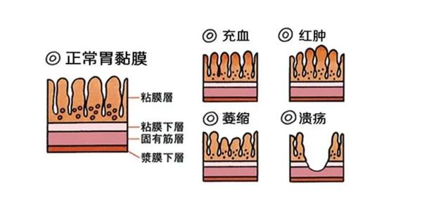 潮汕生腌火爆全国，好医生康复新液提醒：这类人群不宜尝试