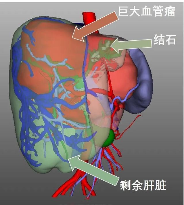 中山医院完成上海首例离体肝切除联合自体肝移植术治疗巨大肝血管瘤和胆管结石患者