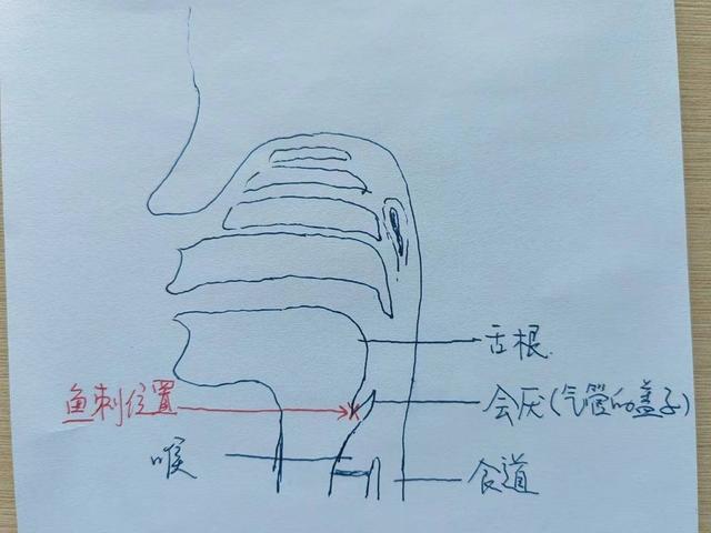 六旬老太太鱼刺卡喉，遇到了会“挑刺”的医生！异物卡咽喉如何“家庭自救”？