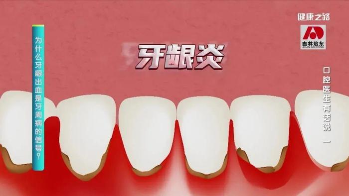 牙齿松动、敏感、牙龈出血……这可能是牙周病，不能拖！