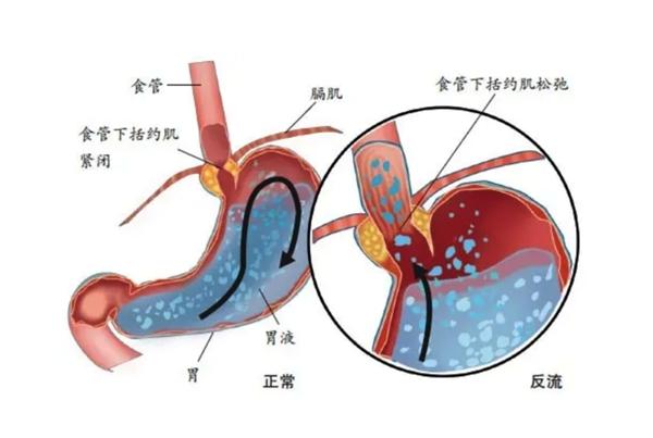 好医生康复新液提醒您，emo也是胃病的“元凶”