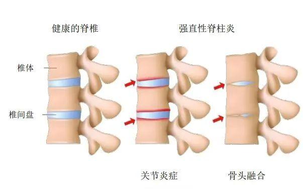 李宇春患的“不死的癌症”，为何国内确诊时间平均延误6年？