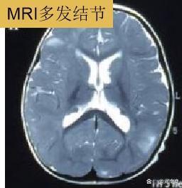 孩子脸上长白斑，是肚里有虫，是白癜风？NO！也有可能是这种遗传性罕见病！