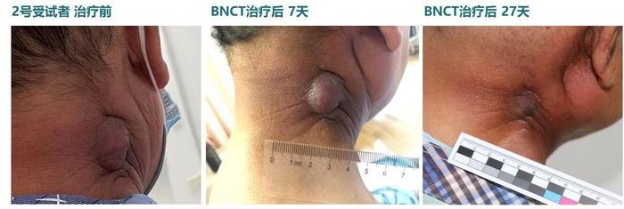 受试头颈癌患者经一次治疗后,肿瘤明显缩小