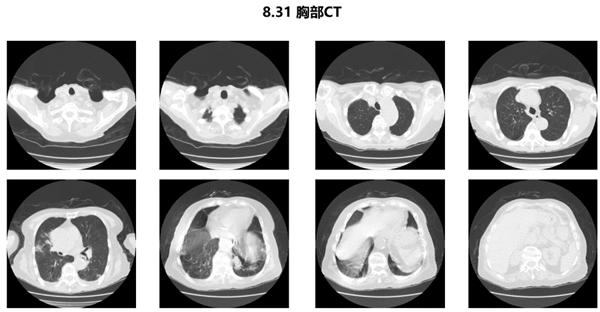 “疫”往无前，“兹”击复阳丨病例分享：阿兹夫定治疗新冠肺炎复阳患者效果显著