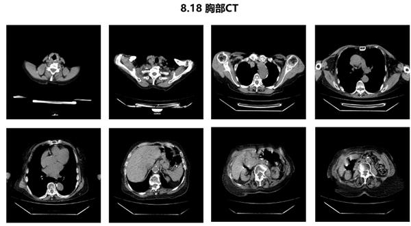 “疫”往无前，“兹”击复阳丨病例分享：阿兹夫定治疗新冠肺炎复阳患者效果显著