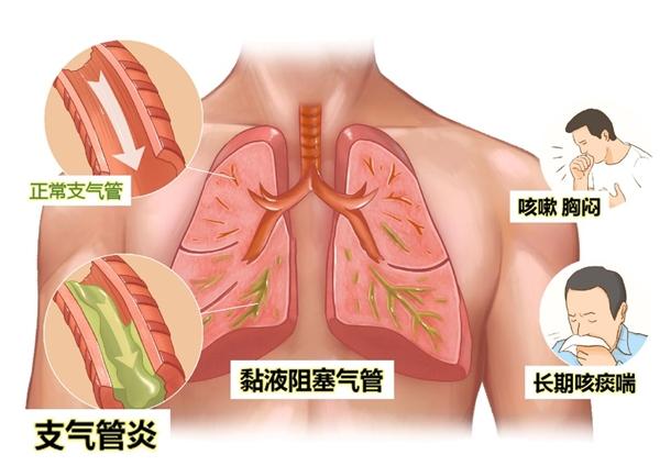 慢性肺病患者自述：“坚持补肺一年后，我不需要住院治疗了”