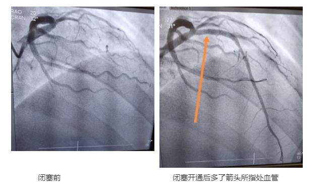 小伙阳了后胸闷，医生一查惊了！呼吸困难、血氧饱和度低…这个救命姿势记住→