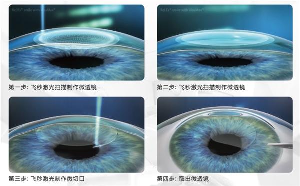 宿迁爱尔眼科医院提醒您：“2023年征兵入伍做近视手术入伍后享受2000元慰问金”!