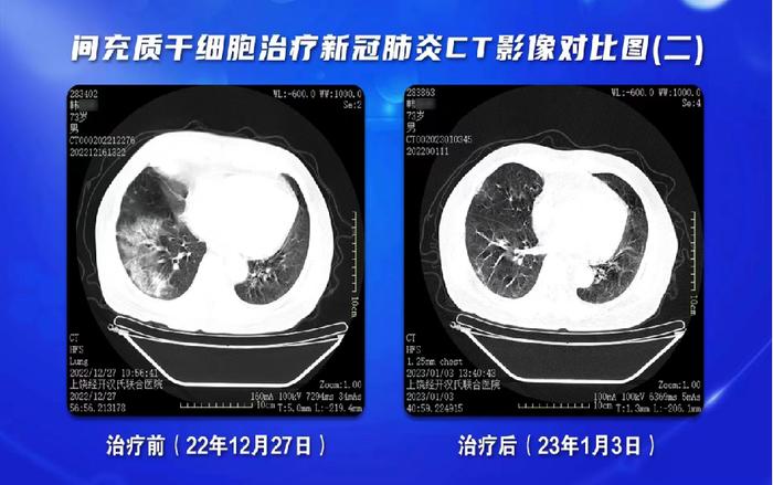 汉氏联合集团上饶经开汉氏联合医院：干细胞治疗白肺安全、有效