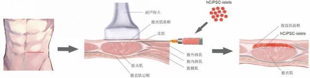 干细胞治疗糖尿病又有新突破！瑞普晨创在Nature Metabolism发布胰岛移植新策略