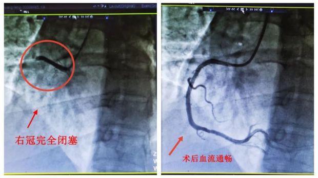 重要提醒！阳性1个月后，这类风险增加33倍！医生：胸闷气急是危险信号