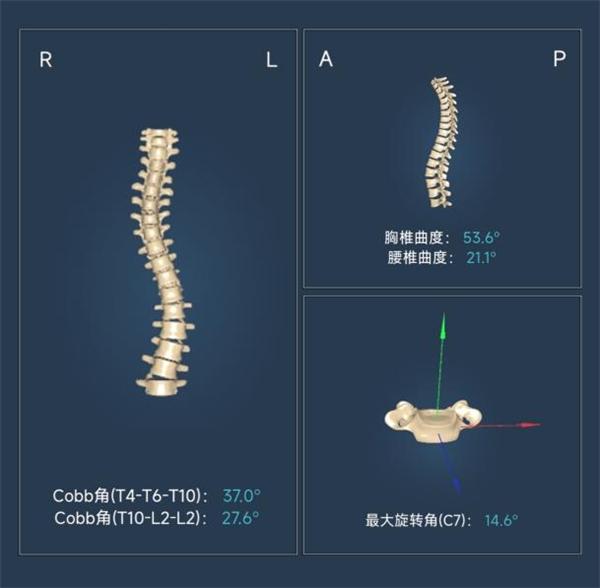 芙索特完成数千万Pre-A轮融资，助力全球儿童青少年脊柱侧弯筛查与诊疗