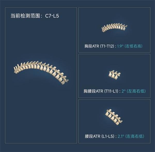 芙索特完成数千万Pre-A轮融资，助力全球儿童青少年脊柱侧弯筛查与诊疗