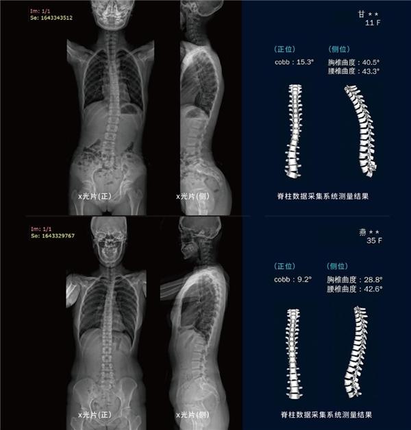 芙索特完成数千万Pre-A轮融资，助力全球儿童青少年脊柱侧弯筛查与诊疗