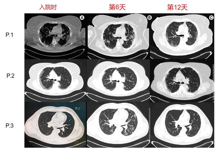 尼妥珠单抗阻断EGFR信号通路，一种新的COVID-19治疗策略？