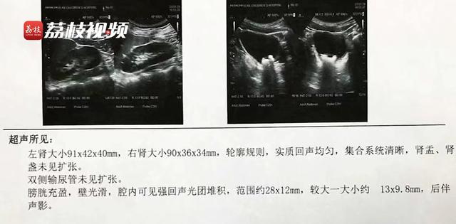 11岁男孩膀胱内取出19颗磁力珠，串联长度约10公分，医生：他一年前塞入下体，因性格内向没对外说