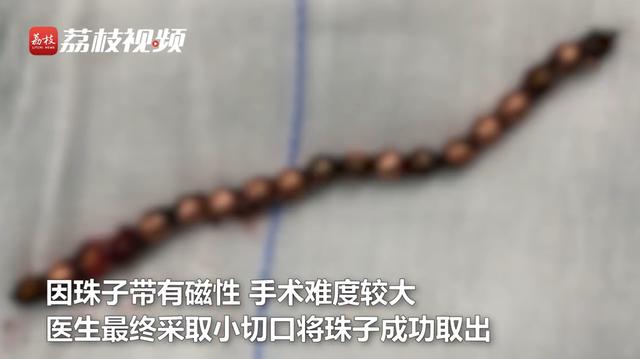 11岁男孩膀胱内取出19颗磁力珠，串联长度约10公分，医生：他一年前塞入下体，因性格内向没对外说