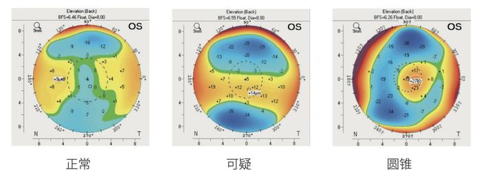 普通人该怎么迅速看懂断层角膜地形图？