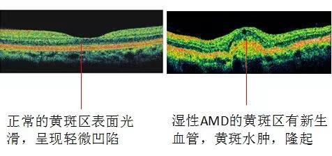 双眼“六步检查”让老年黄斑变性无所遁形