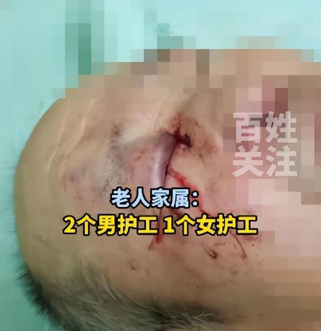 73岁患阿尔兹海默症老人在养老院被护工殴打，右眼眼球破裂失明，警方：已刑事立案