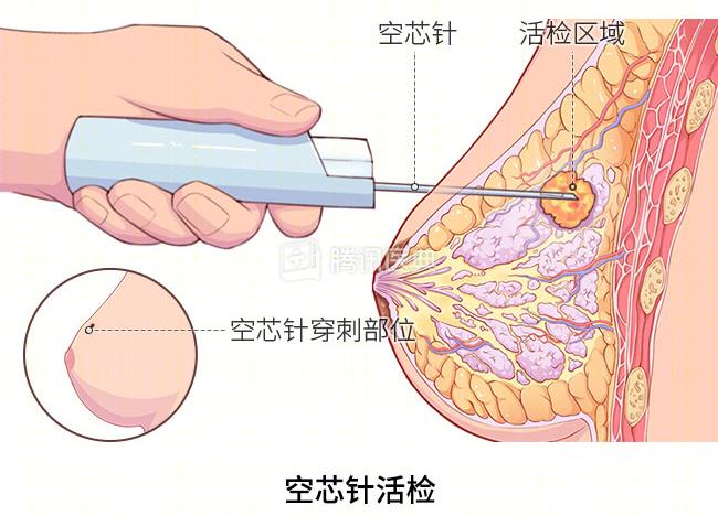 妇科医生让做的“活检”，到底是什么？