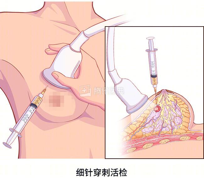 妇科医生让做的“活检”，到底是什么？