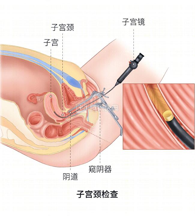 妇科医生让做的“活检”，到底是什么？