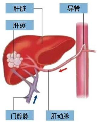 肝癌治疗再添“重磅武器”，这5类患者推荐考虑选择！