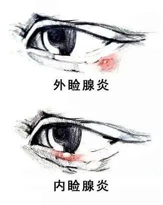 麦粒肿（俗称“针眼”）是怎么回事？