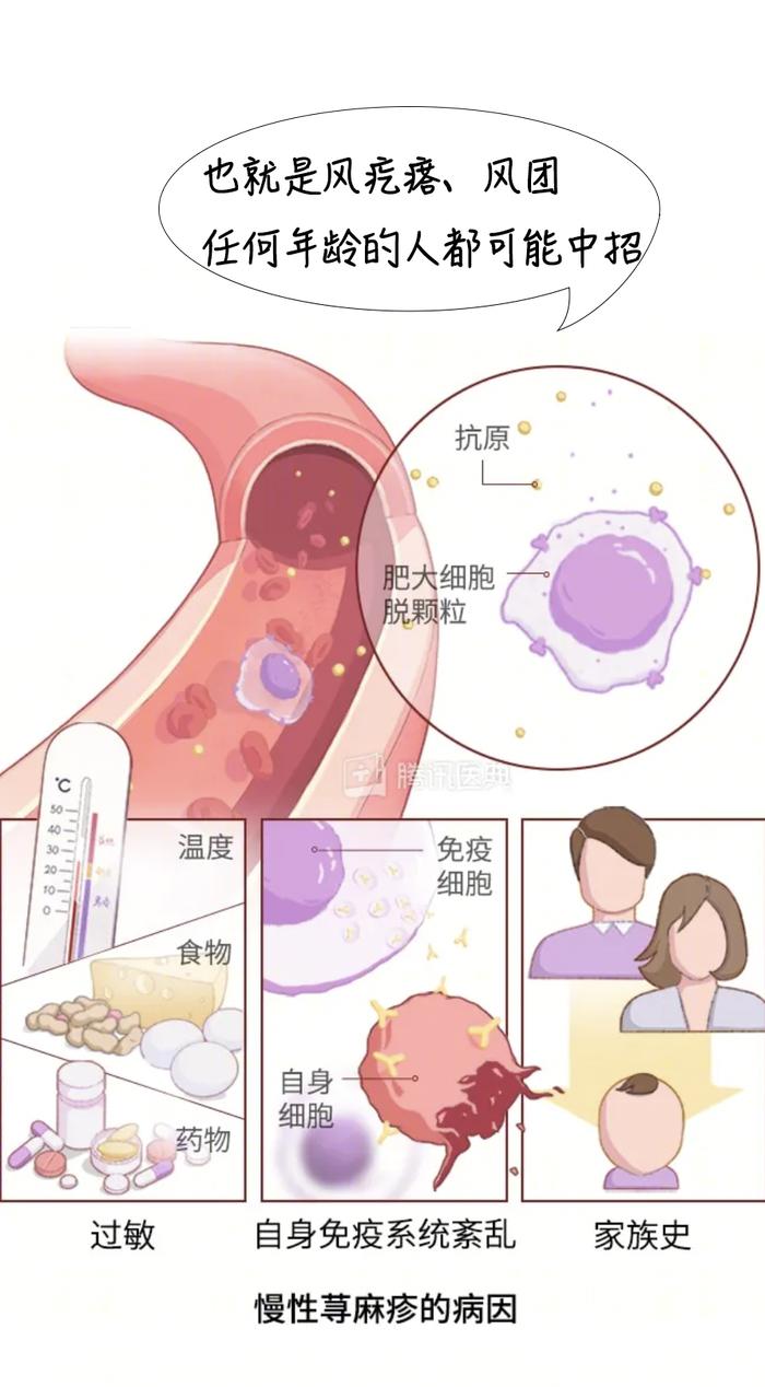 慢性荨麻疹为什么晚上容易发作？