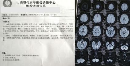 悦康通悦耳优秀病例之一：持续性眩晕伴前庭神经炎的女性患者