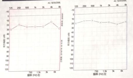 悦康通悦耳优秀病例之一：持续性眩晕伴前庭神经炎的女性患者