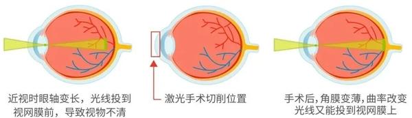 合肥普瑞专家提醒：不是人人都能做，近视手术的最佳年龄及度数